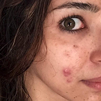 DERMATOLOGIST UPLOADS INSTAGRAM PHOTO OF HER ADULT ACNE TO BREAK STIGMAS